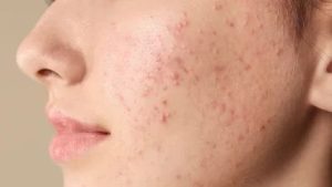 erawat Bandel? Kesalahan Perawatan Kulit yang Sering Terjadi